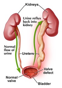 Urinary Infection