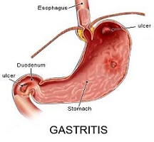 gastritis