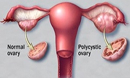 Poly Cystic Ovaries